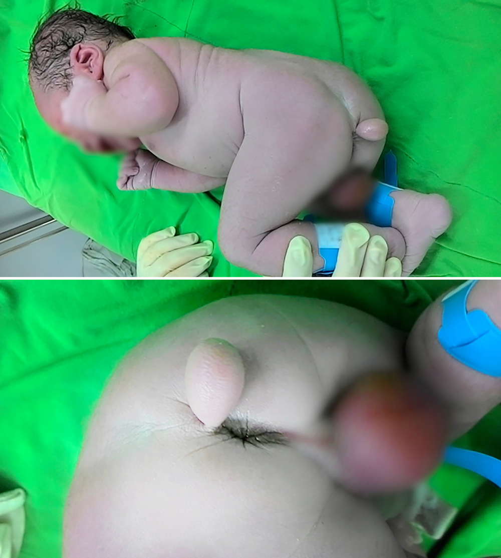 罕見！寶寶天生「橢圓尾巴」7年後現況感動千人