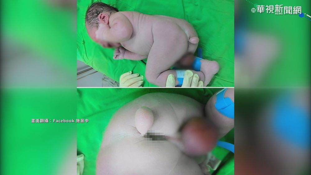 新生小男嬰長尾巴? 醫師:手術切除無礙