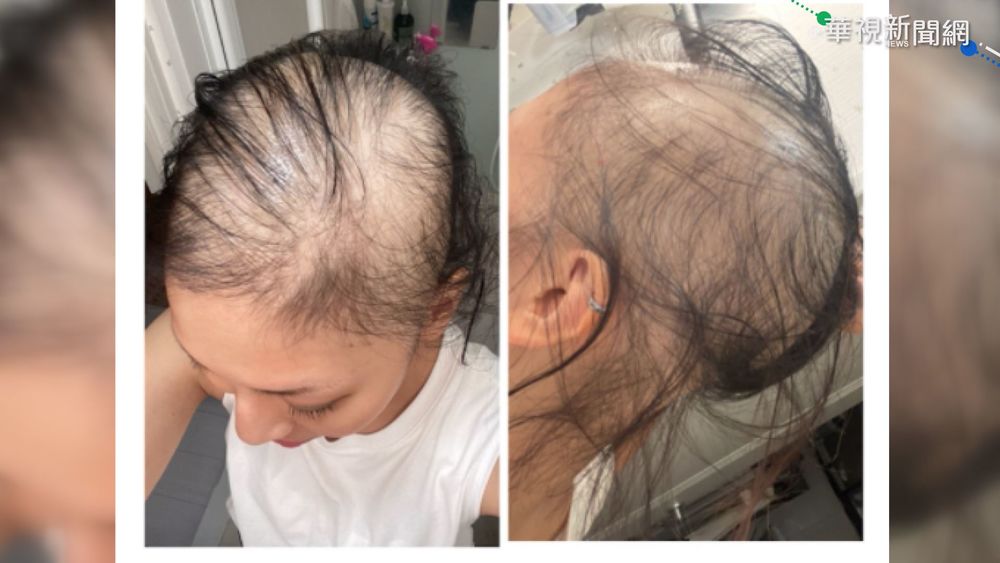 日女打莫德納掉髮 一個月後竟禿頭