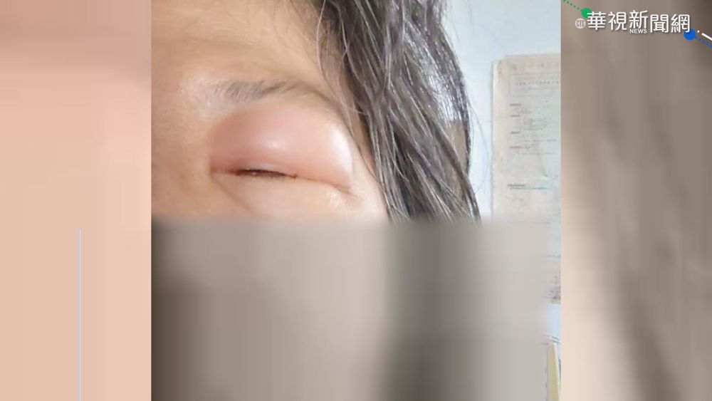 螞蟻入侵眼睛! 婦人睡醒變"豬頭妹"