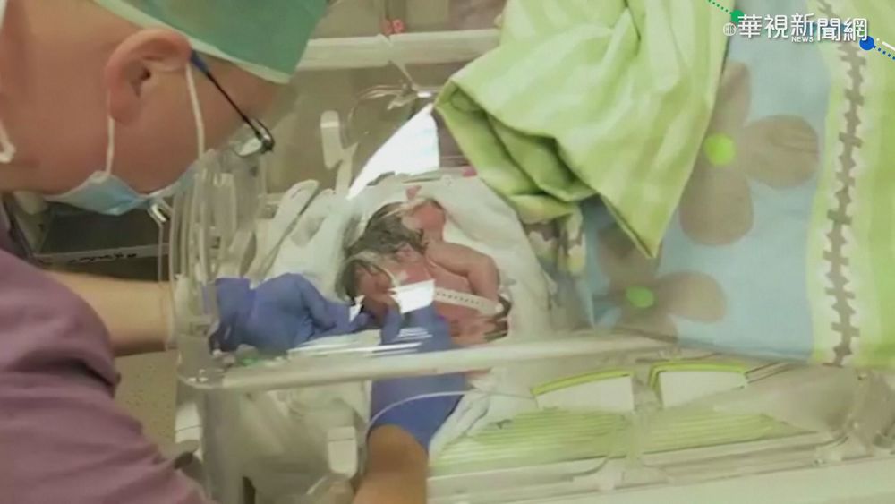 以國首起"連體嬰分離手術" 姊妹相見歡