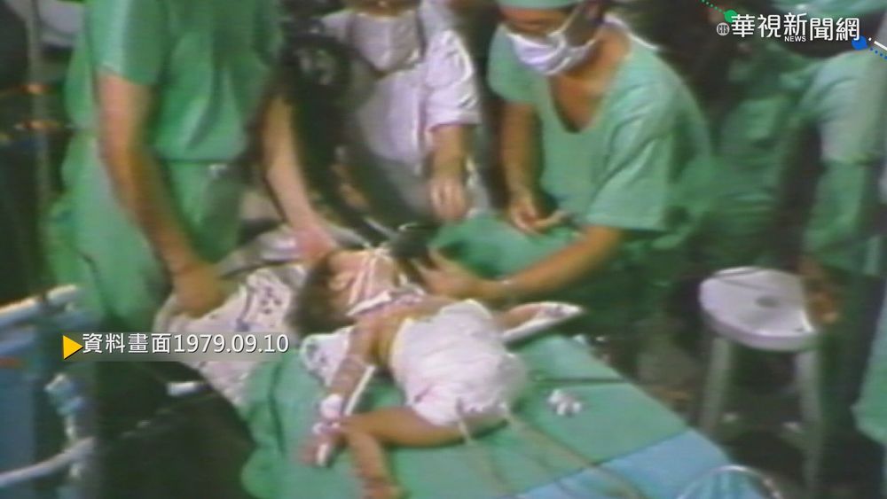 【歷史上的今天】卅多醫護動手術 分割連體雙胞兄弟