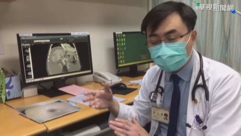 肚臍周圍"瘀青" 壯年男就醫已肝癌末