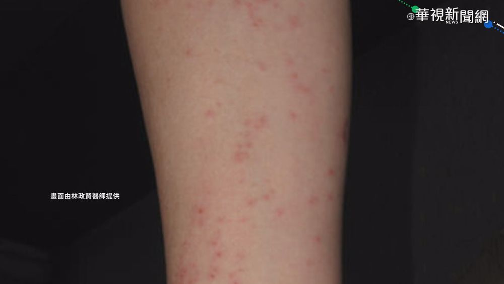 澎湖"紅疹怪病" 醫:不排除毛毛蟲皮膚炎