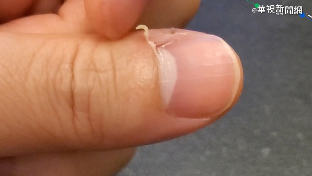 防疫勤洗手噴酒精 指甲倒刺發膿感染