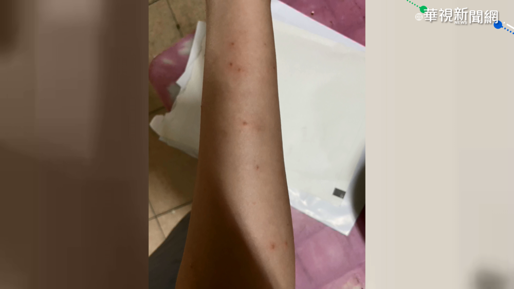 澎湖"紅癢病"傳到恆春? 皮膚科患者暴增