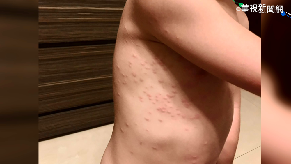 蟲蟲危機! 入住墾丁民宿全身紅腫發癢