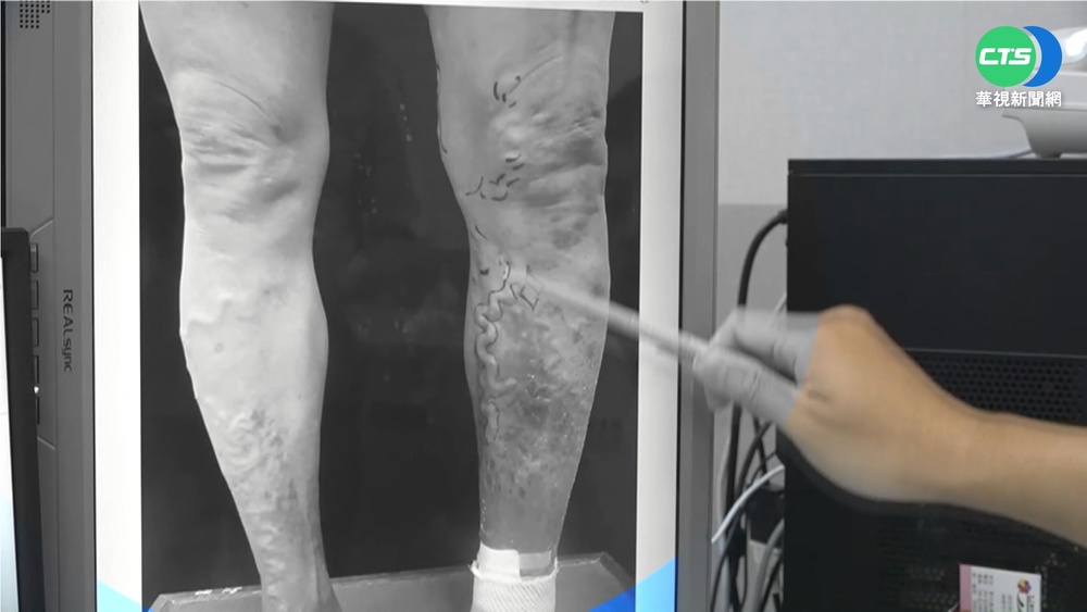 小腿如"蚯蚓爬" 廚師久站靜脈曲張癢痛