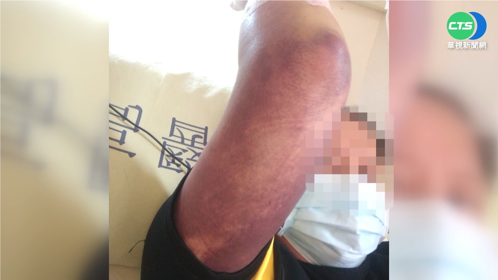打完BNT全身血疹.牙齦出血 高雄男送醫