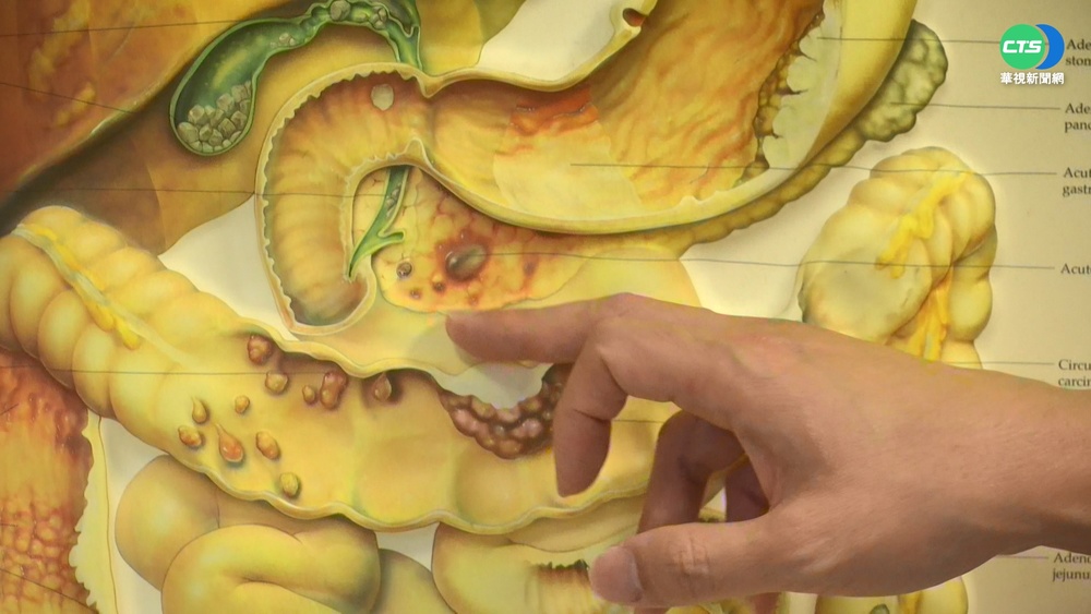 無聲殺手! 壺腹癌不易發現 有症狀已晚期