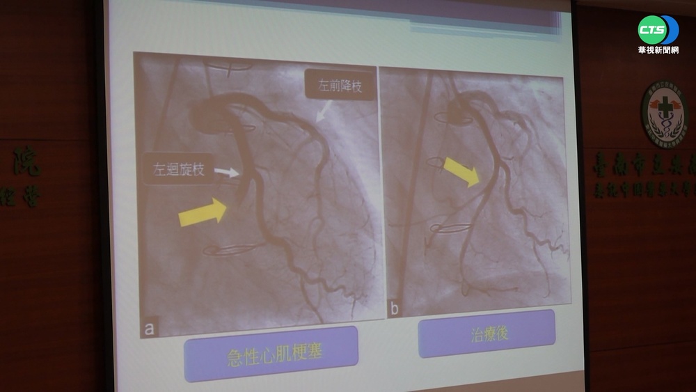 男牙痛近1個月 動脈阻塞險丟性命