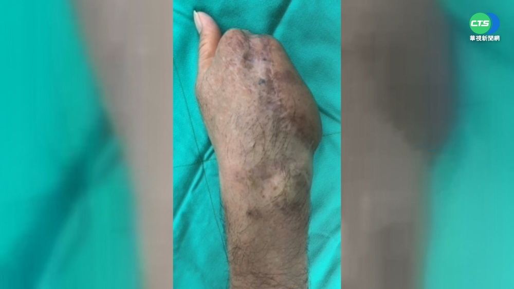 腳趾接手指! 久違提筆寫字.拿筷吃飯