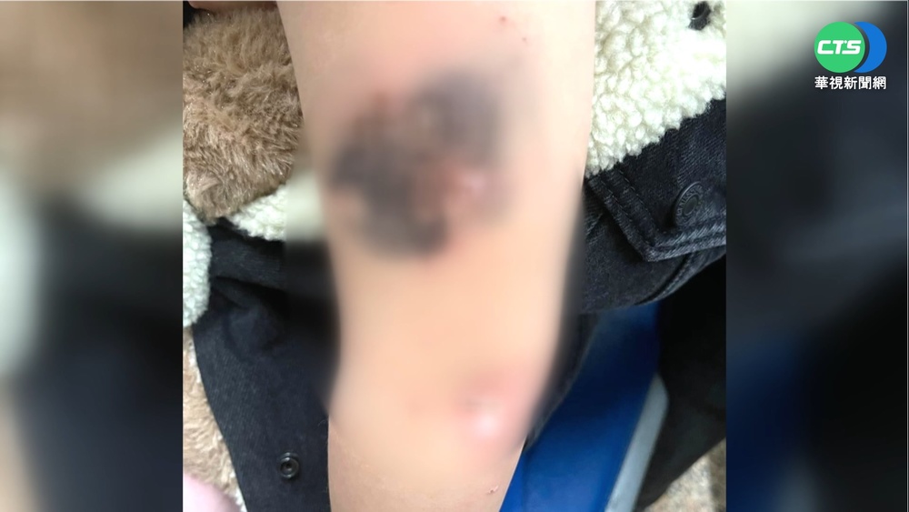 大樓電線裸露"啪"一聲 女童手臂被燒黑