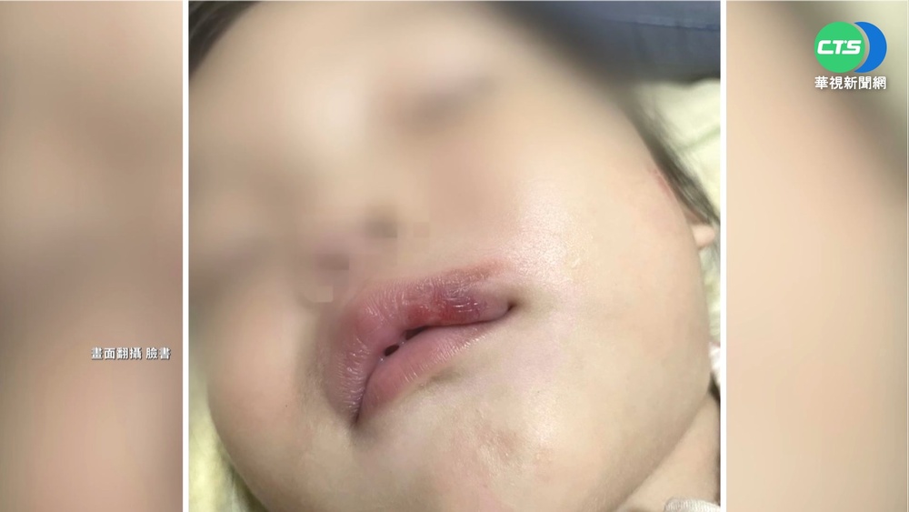 男童玩公園設施疑不當 女童遭撞嘴濺血