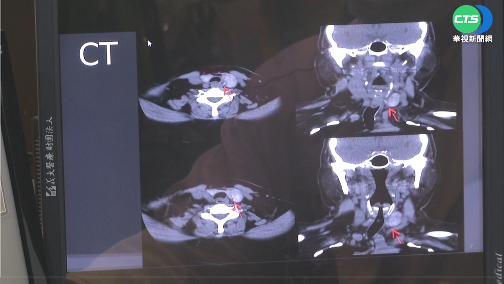 魚刺穿破食道插進甲狀腺 婦人險喪命!