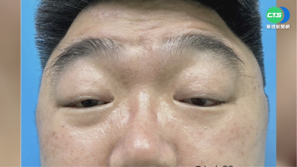 男提眼肌無力遭誤會"打瞌睡" 常被師罰站