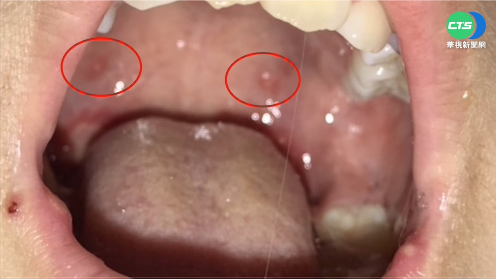 爸爸送個吻! 雙胞胎染"泡疹性齒齦舌炎"