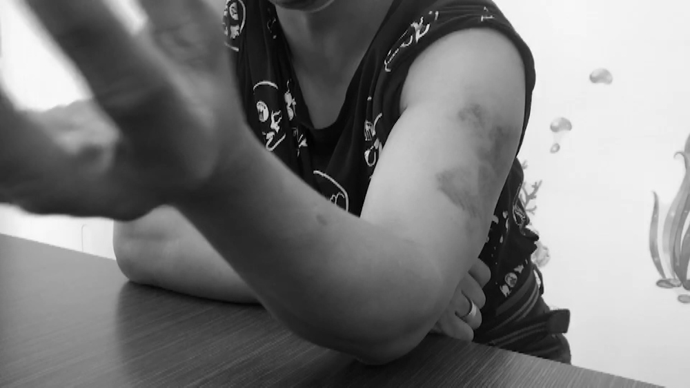 打工疑動作慢遭老闆毆打 輕障男全身傷