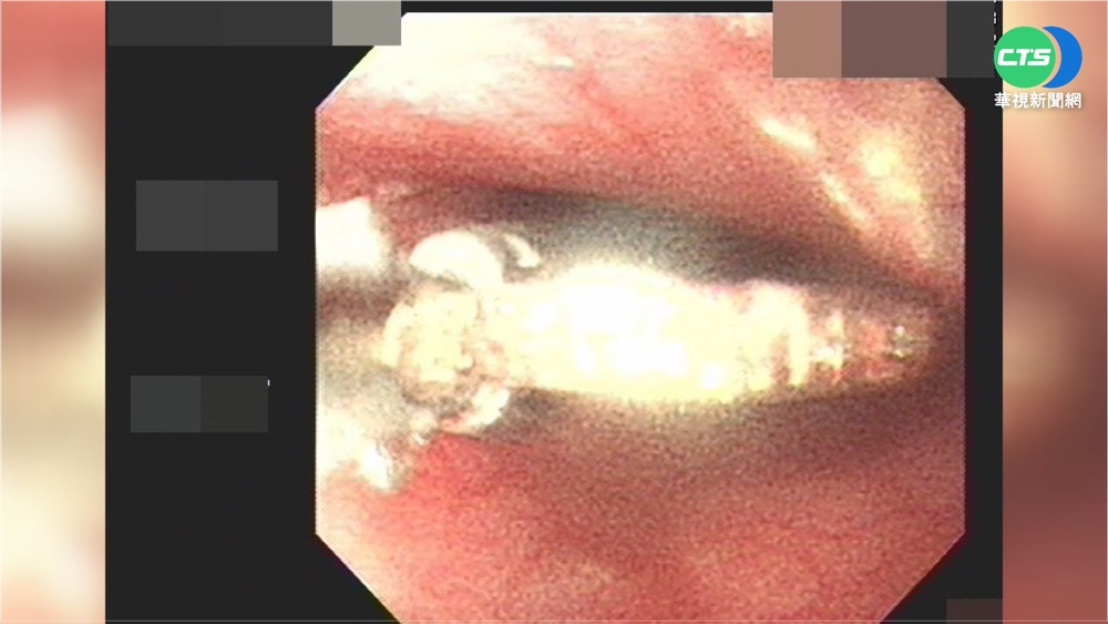 注意! 魚刺卡喉怎辦? 喝醋.吞飯都NG