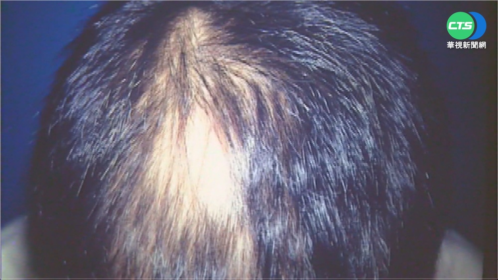 接種後鬼剃頭? 疑疫苗T細胞襲毛囊落髮