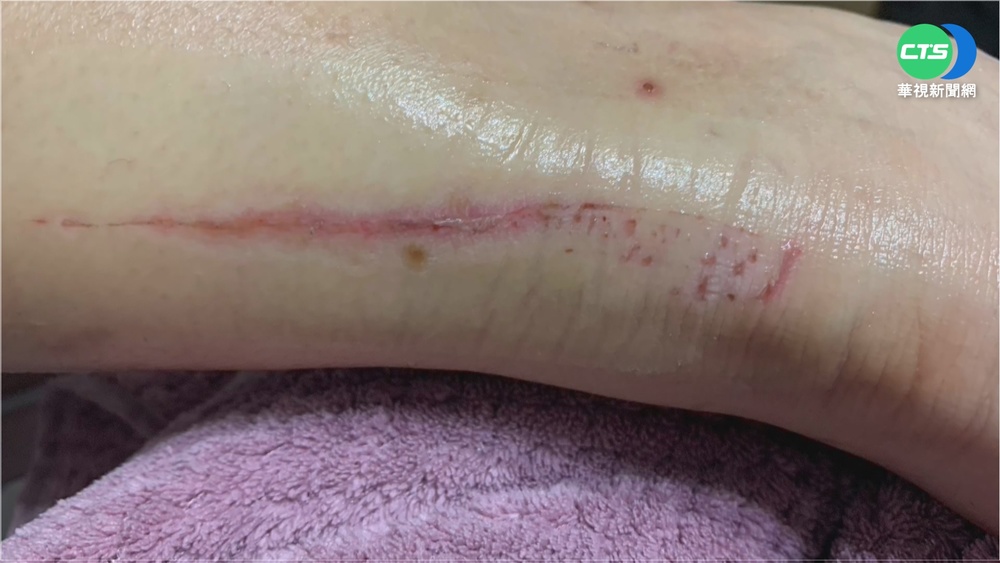 人行道破大洞! 女逛夜市跌進坑受傷