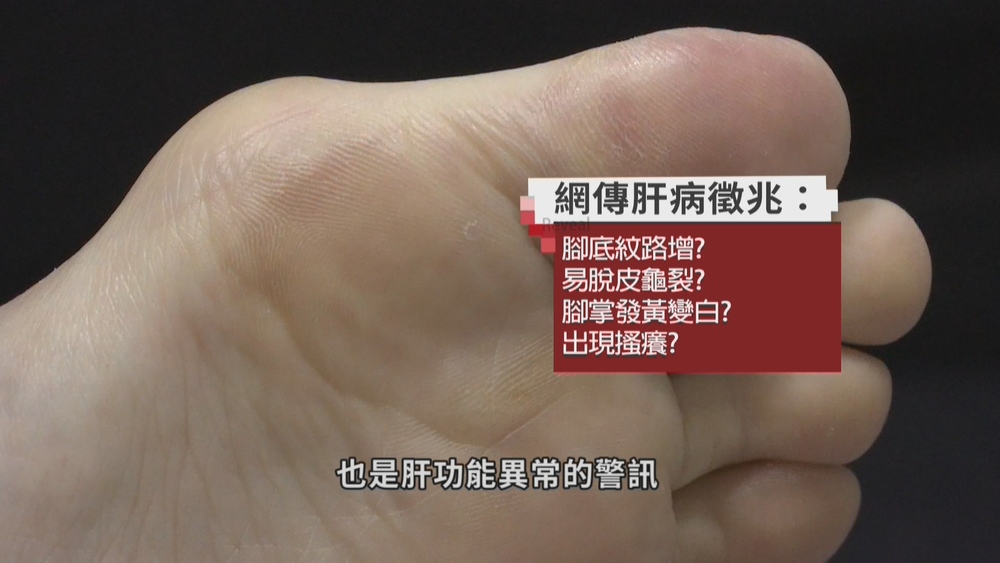 腳底蠟黃.紋路變多 肝臟求救的訊號?