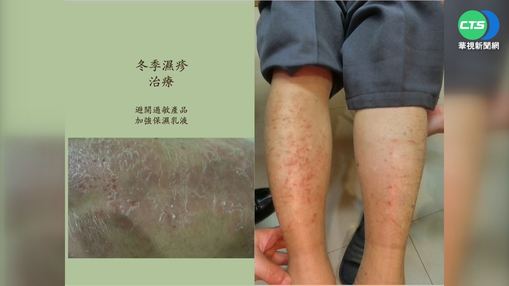 天冷皮膚乾癢難耐! 過敏求診增3成