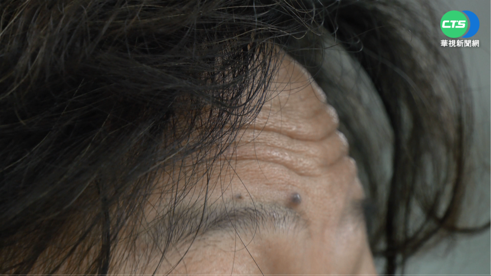 前額"皺紋多" 心血管疾病致命率恐飆10倍