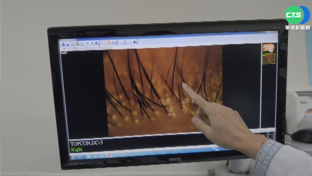 男熬夜打遊戲眼乾癢 驚見"蟎蟲"爬滿睫毛