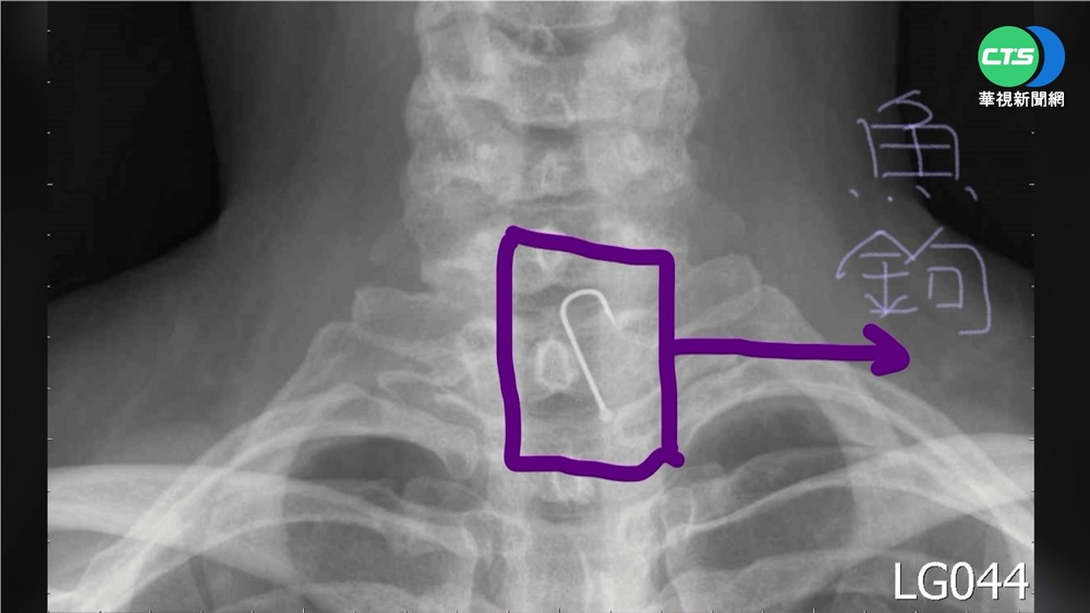 婦感冒就醫 喉嚨驚見卡2.5公分魚鉤