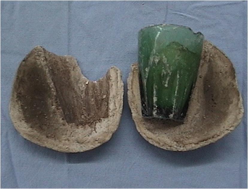 婦人為「情趣」玻璃杯塞下體 卡4年不敢就醫成巨大結石