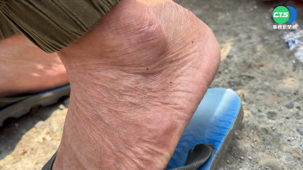 嘉縣小黑蚊來襲 民眾滿身包直呼"凍袂條"