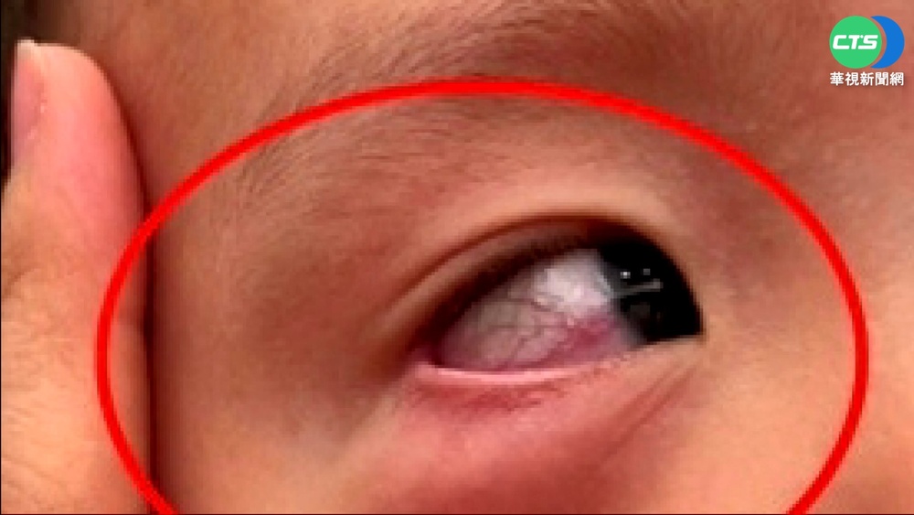 1歲童送托多處有傷 父質疑遭"不當對待"