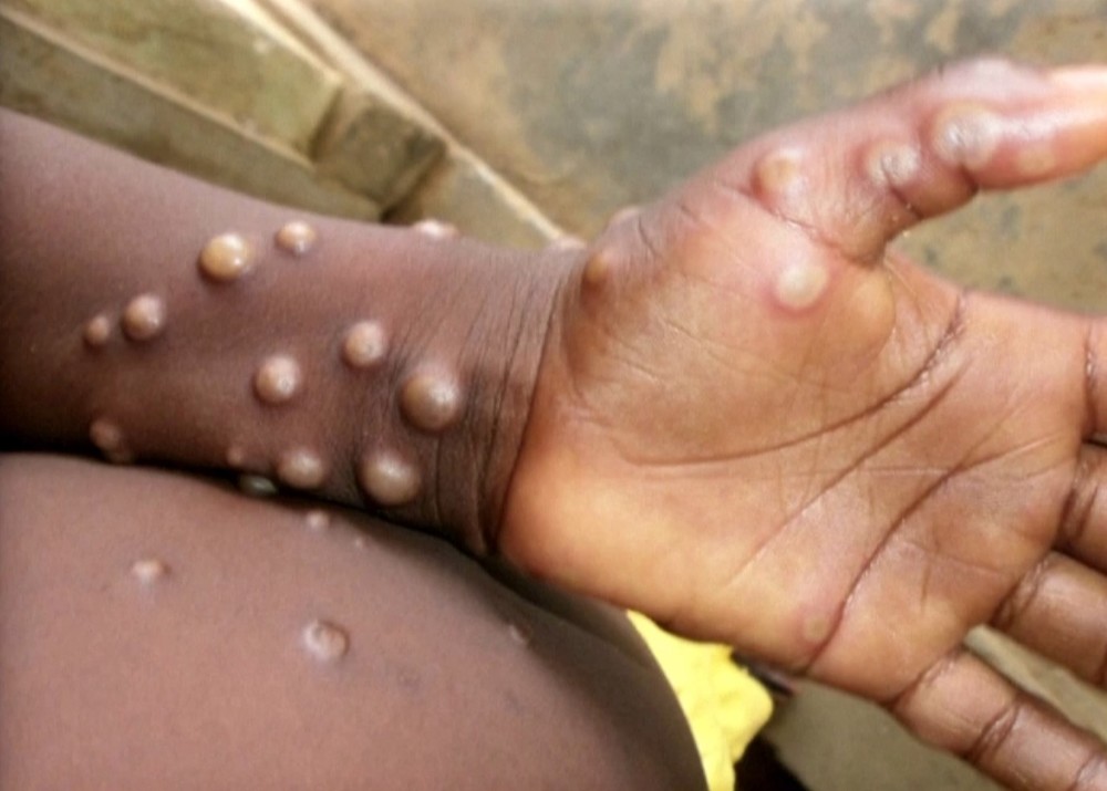 猴痘傳16國 世衛專家：恐和歐洲2場派對危險性行為有關