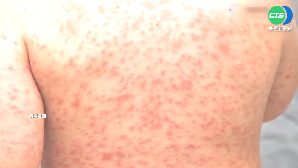 台首例MIS-C 10歲男童輕症癒後高燒休克