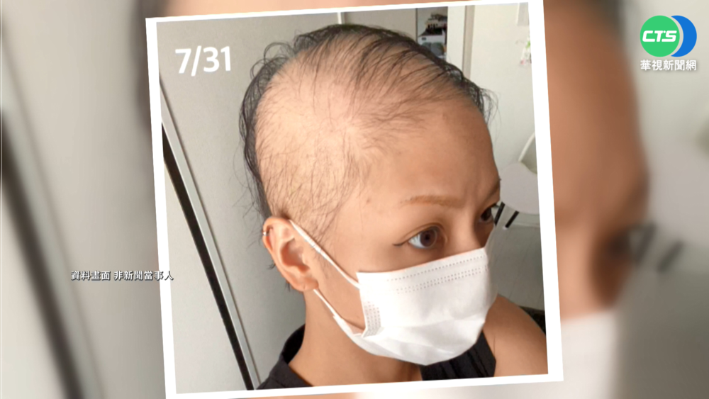 30多歲男打AZ"圓禿" 獲2萬元救濟金