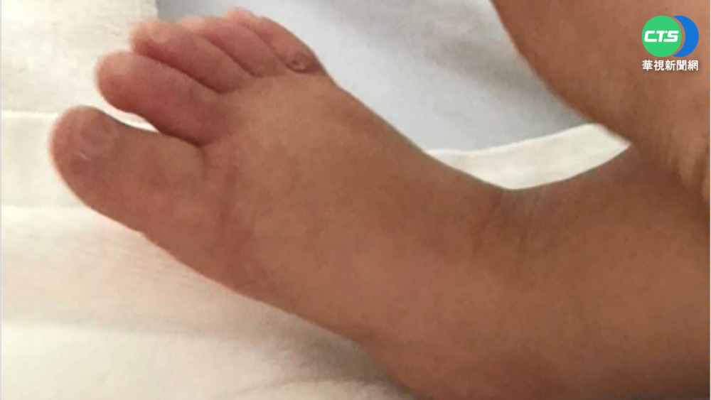 高雄2歲童MIS-C 高燒膿尿出院又復發