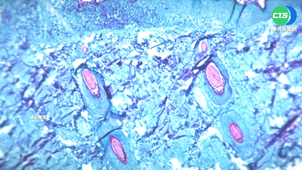 全球猴痘延燒 世衛下周召開緊急會議