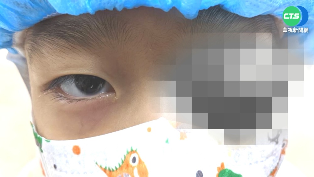 玩澆花水槍射眼 7歲童眼珠歪掉"消失"