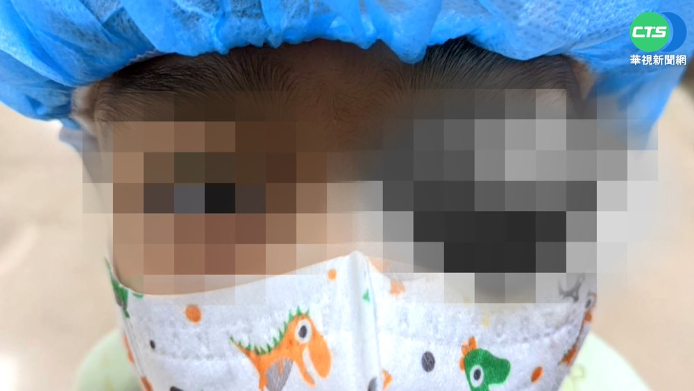 玩澆花水槍射中眼 7歲童眼珠歪掉"消失"