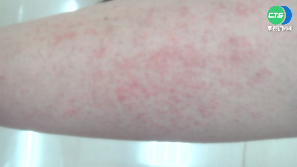 新冠康復後長"丘疹" 皮膚科醫:患者增3成