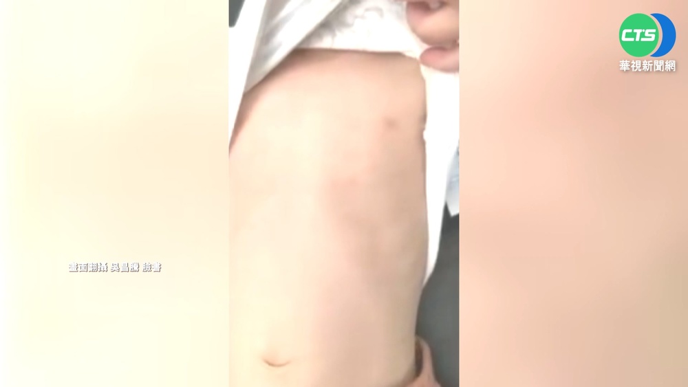 確診童哮吼驚見胸凹 醫:類似徵兆要有警覺