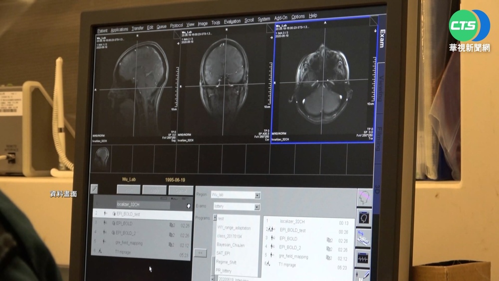 "忘了怎麼結帳拿錢" 醫曝30歲女康復腦霧