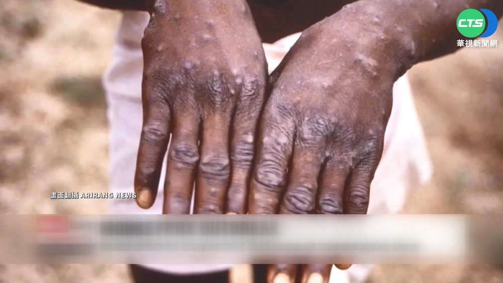 台灣爆首例猴痘 20多歲男自德返台確診