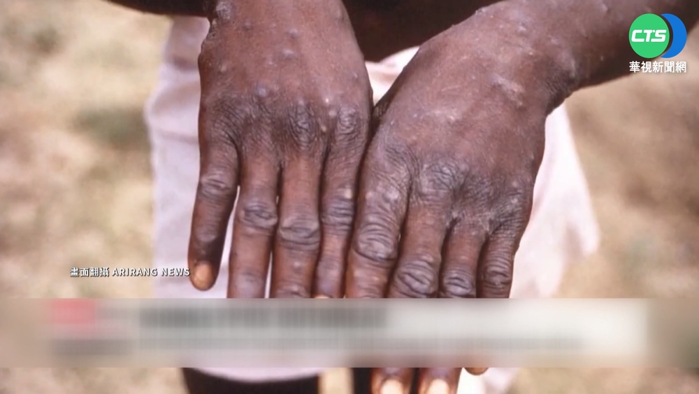 台首例猴痘! 25歲男德國返台確診.匡列19人