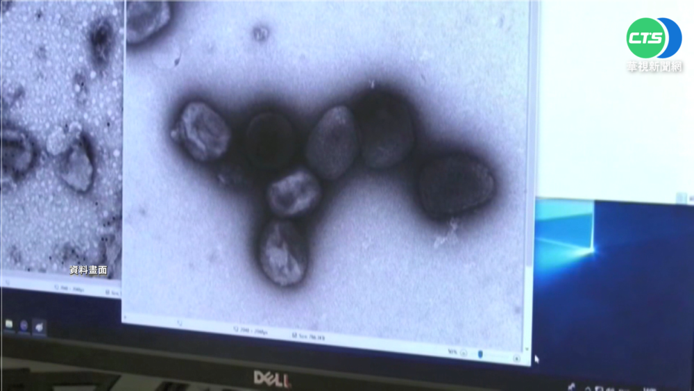 台首例猴痘! 25歲男由德返台確診.匡列9人