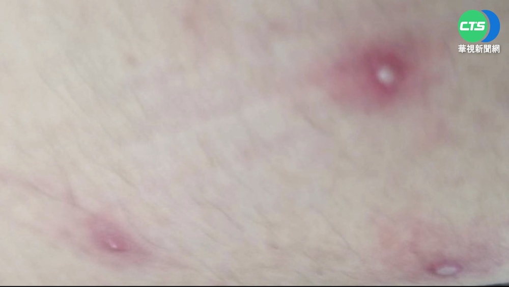 台首例"猴痘"病況曝! 25歲男大腿冒小水泡