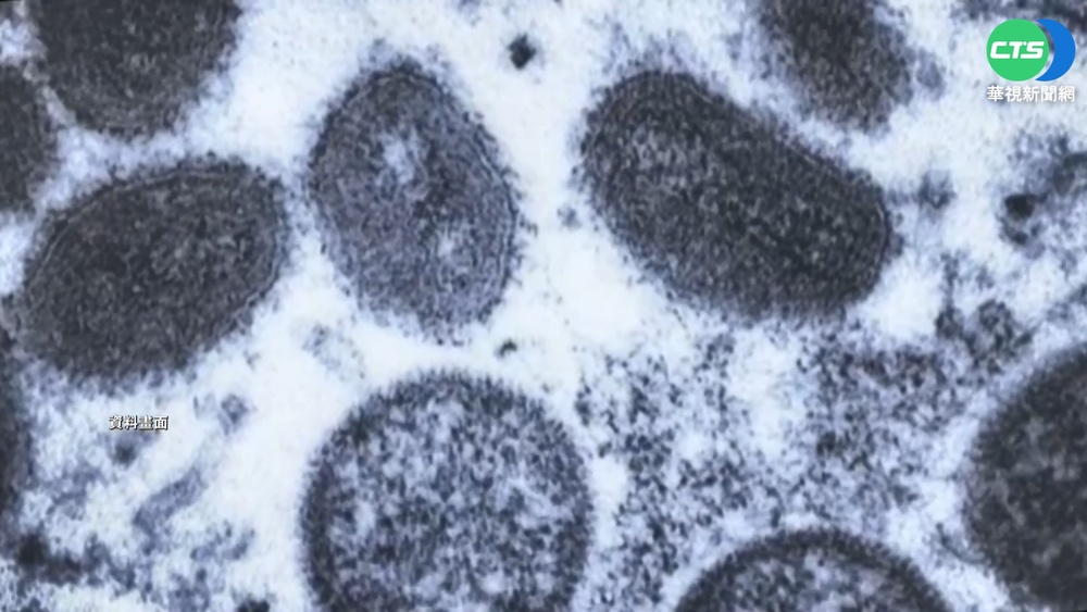 法首例孩童感染猴痘! 專家曝3大危險族群