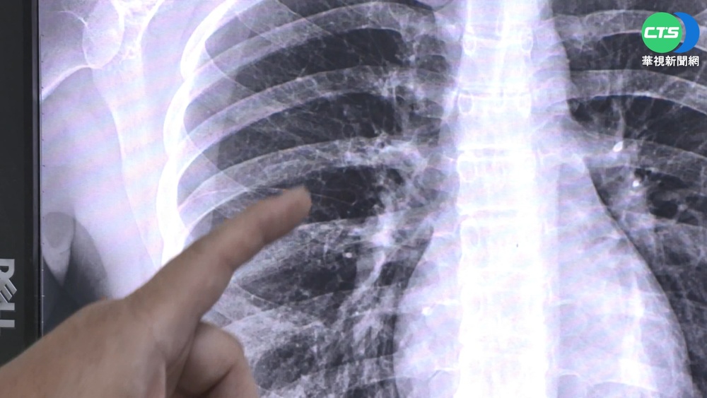 以為長新冠! 連咳5周 竟是確診+黴漿菌惹禍