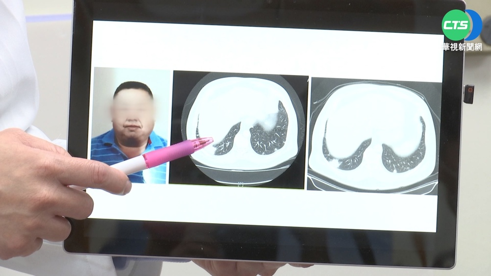 5寶爸罹癌買不起救命藥 仁醫向外界求助